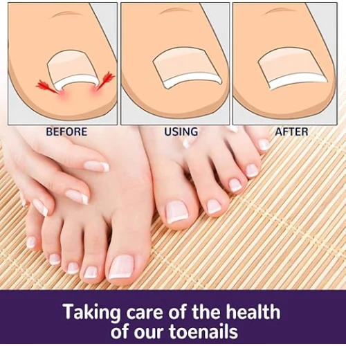 Ayak Tırnağı Düzeltme Bandı 50 Adet - 3