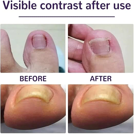 Ayak Tırnağı Düzeltme Bandı 50 Adet ürün görseli