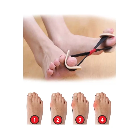 Ayak Baş Parmak Kemik Düzeltici Egzersiz Lastiği - 3