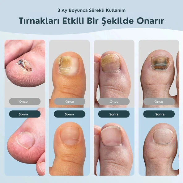 ShoptTech 36W Katlanabilir Tırnak Mantarı Işık Cihazı El ve Ayak Tırnağı İçin LED Fototerapi Lambası, USB Şarjlı - Resim 8