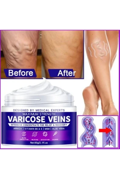 HBPAVM Strength Varicose Vein Tedavi Kremi 100 Ml X 3 ADET - Resim 2