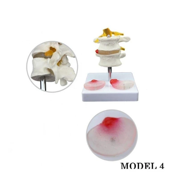 Lumbar Vertebra Disk Hernisi Omurga Modeli Model 4 - 2