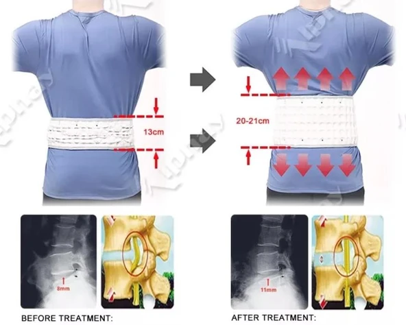 Bel Manuel Terapi ve Bel Traksiyon Korsesi - Resim 5