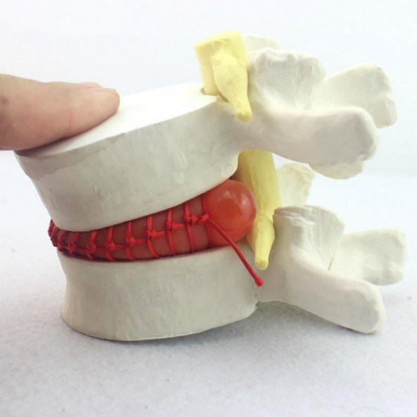 Disk Hernisi Fıtık Maketi Model 2