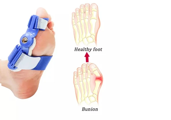 HALLUKS VALGUS GECE ATELİ AYAK PARMAK AYIRICI ATELİ BUNYON PARMAK ARASI MAKARA FULL SET - 8