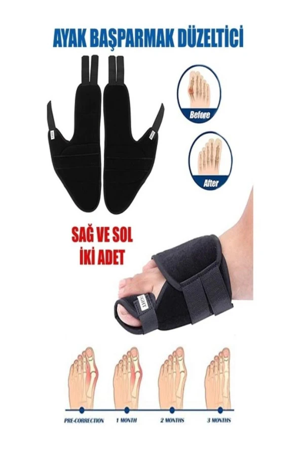 Halluks Ayak Baş Parmak Çıkıntısı Tedavisi Kemik Düzeltici Gece Ateli (çift ) - Resim 5
