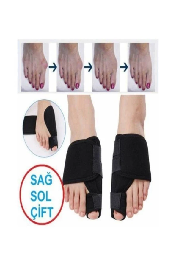 Halluks Valgus Ayak Ateli Ayak Başparmak Kemiği Çıkıntısı Bunyonu Düzeltici - Resim 5