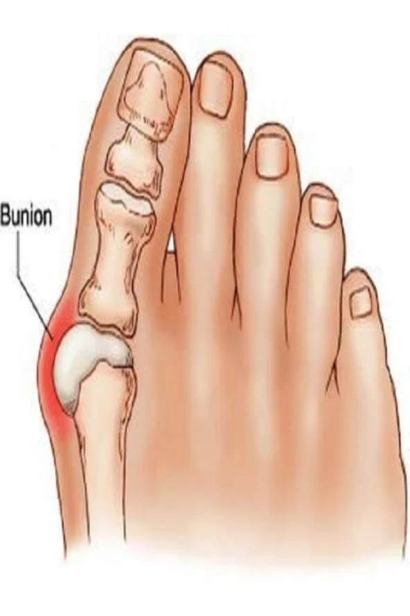 Supportline 2 Adet Halluks Valgus Gece Ateli Halluks - Resim 3