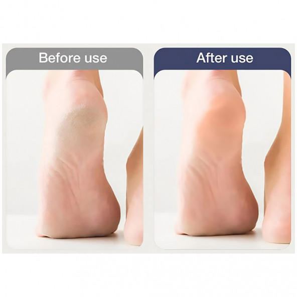 Xiaomi Enchen Şarjlı Ayak Bakım Masajı Nasır Sökücü - 7