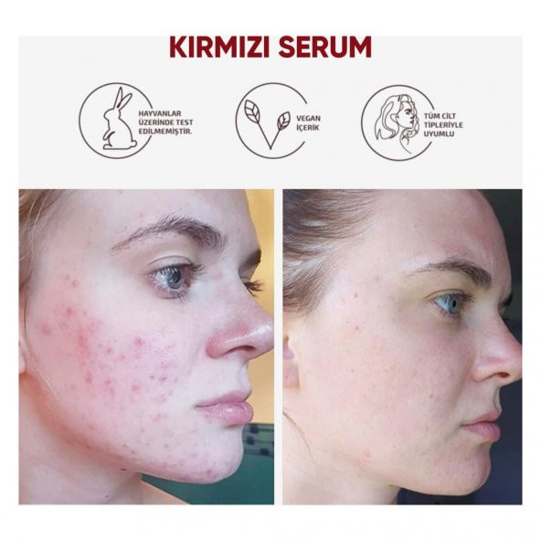 NEDOX Cilt Yenileyici Cilt Tonu Eşitleyici Kırmızı Peeling Serum Aha %30 Bha %2 Ph % 3.5 Serum 30 ml - 5