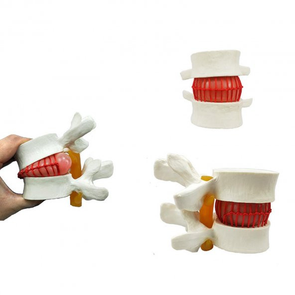Disk Hernisi Fıtık Maketi Model 2 - 2