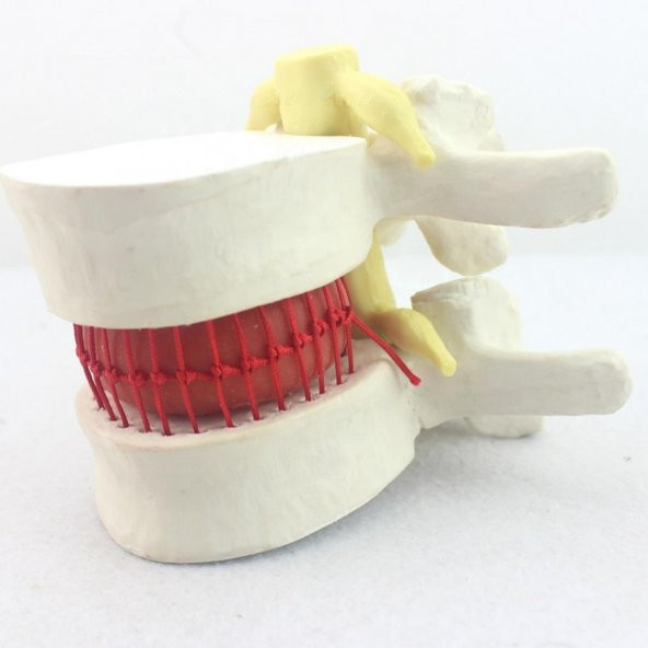 Disk Hernisi Fıtık Maketi Model 2 - 3