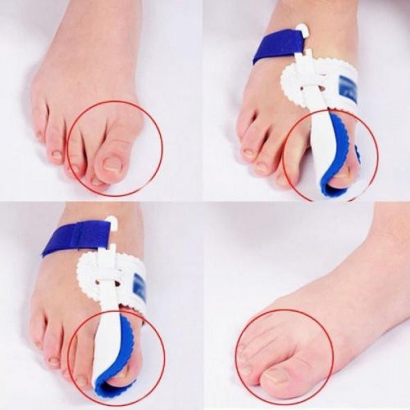 Halluks Valgus Ayak Baş Parmak Ateli Gece Ateli Bunyon Koruyucu Kemik Çıkıntısı Aparatı Kemik Bunyon - 2