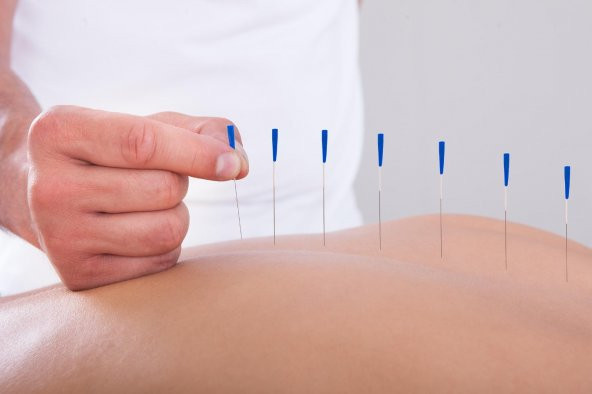 Akupunktur iğnesi
kuru iğne,
Acupuncture needle 0.25*40mm - 2