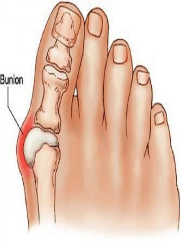 Medical Gece Ateli Ayak Bunyon Başparmak Halluks 2 Adet