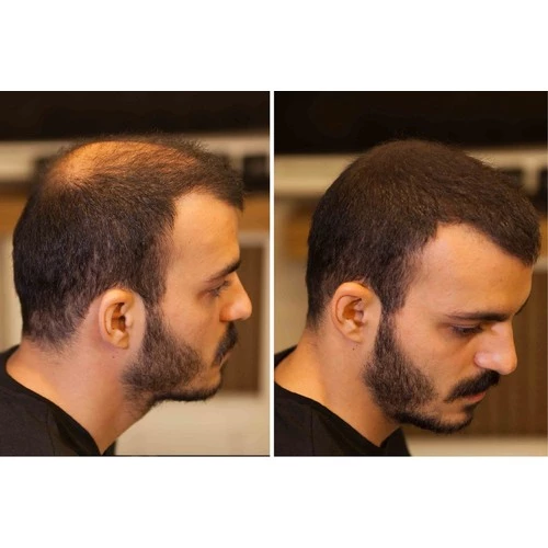 Fixplant 1 Şişe 28 gr Saç Tozu Fiberi - ORTA KAHVE - 2