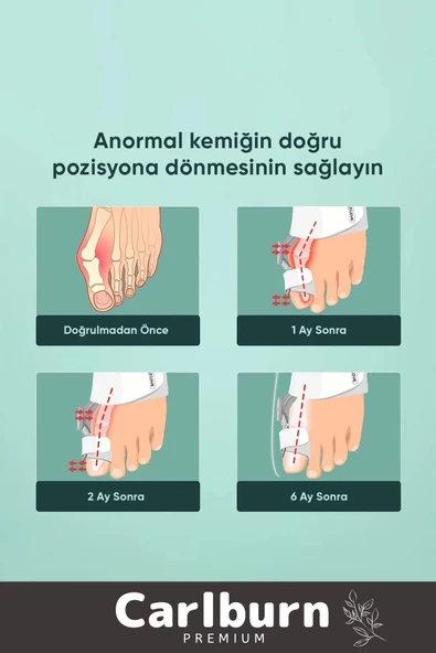 Özel Üretim Yumuşak Yıkanabilir Bedensiz Sağ Sol Ayak Uyumlu Baş Parmak Kemik Düzeltici 2 Adet - 5