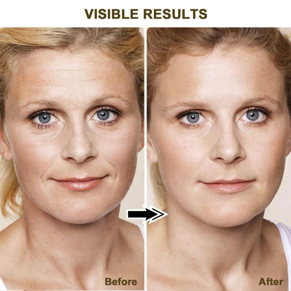 LEFAY Radyo Frekansı Cilt Sıkılaştırma Yüz Makinesi - Yaşlanma Karşıtı Sihirli Değnek - 5