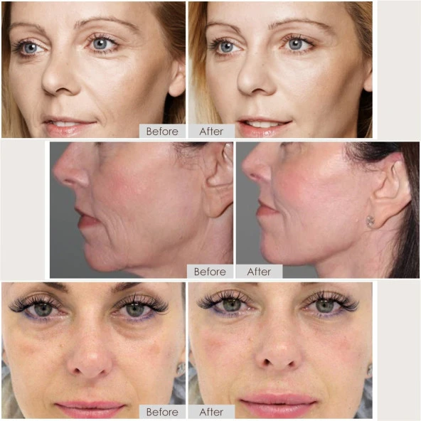 LEFAY Radyo Frekansı Cilt Sıkılaştırma Yüz Makinesi - Mikro Akım Yaşlanma Karşıtı - 3