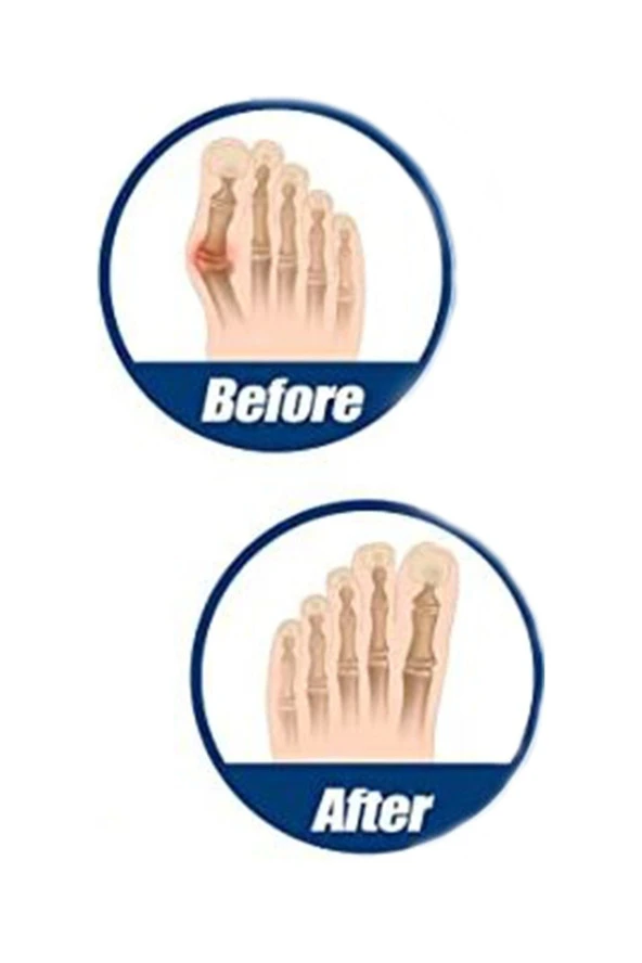 Ayak Başparmak Kemiği Çıkıntısı Bunyonu Düzeltici Halluks Valgus Ayak Sağlığı Ateli 1 Çift - 3