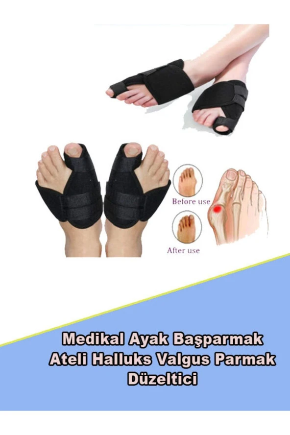 Ortopedik Halluks Valgus Ayak Başparmak Ateli Ayak Başparmak Kemik Düzeltici Atel 2 Li Set