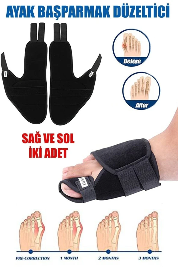 Ayak Başparmak Kemiği Çıkıntısı Bunyonu Düzeltici Halluks Valgus Ayak Sağlığı Ateli 1 Çift