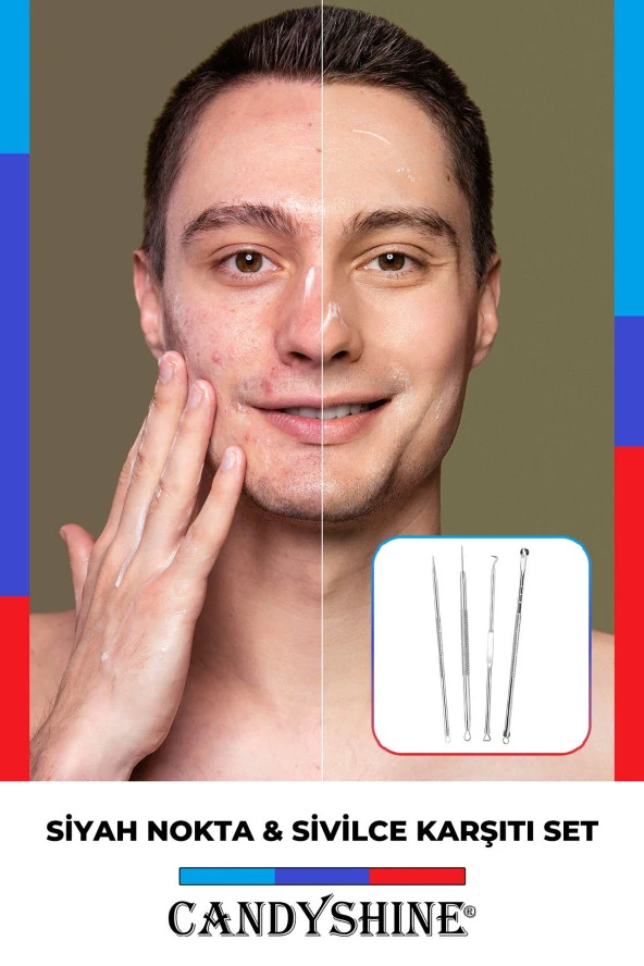 Akne & Siyah Nokta Temizleyici 4'lü Set Paslanmaz Çelik Bakır Komedon - 4