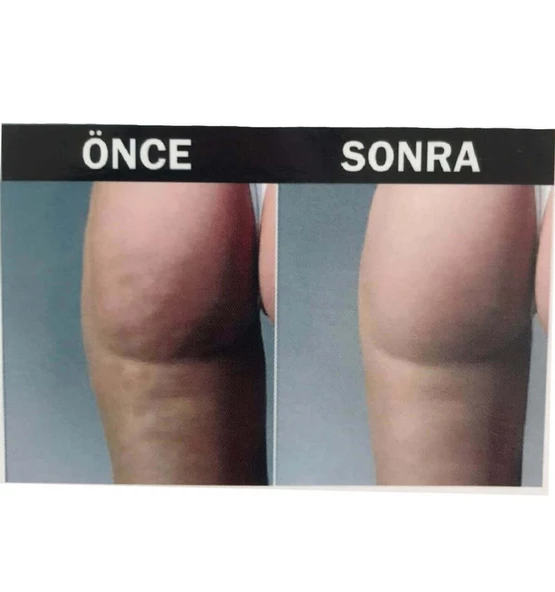 Hema Kadın Anti-Cellulite ( Selülit Giderici ) Masajlı Dikişsiz Paçalı Korse - 11