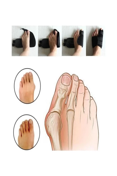 1 Çift Ayak Baş Parmak Kemik Çıkıntısı Için Aparat Ayak Parmağı Bunyonu Ayak Ateli Halluks Valgus - 4