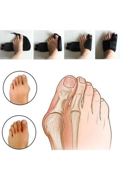 Ankaflex Halluks Ayak Baş Parmak Çıkıntısı Tedavisi Kemik Düzeltici 2li Gece Ateli - 2