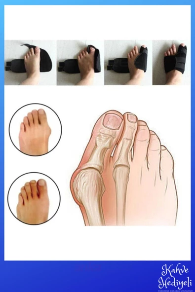 Halluks Valgus Gece Ateli Ayak Baş Parmak Kemik Çıkıntısı Düzeltici Bunyon Tedavisi - 3
