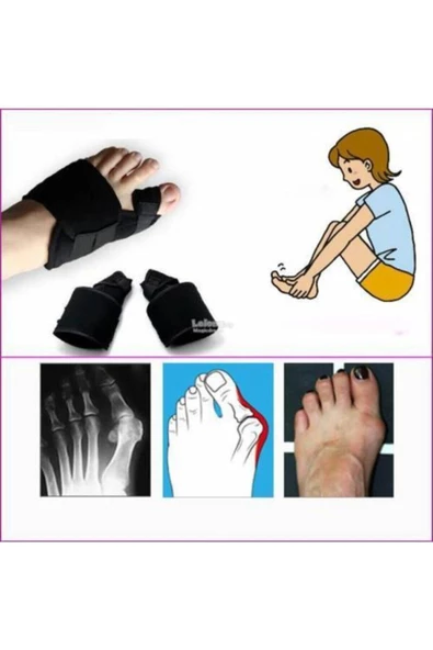 Halluks Valgus Gece Ateli Ayak Baş Parmak Kemik Çıkıntısı Düzeltici Bunyon Tedavisi - 7