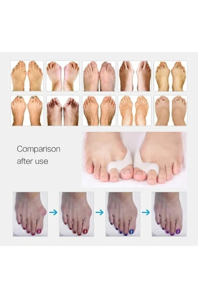 Orta Parmağa Geçen Metatarsal Pad - Resim 2