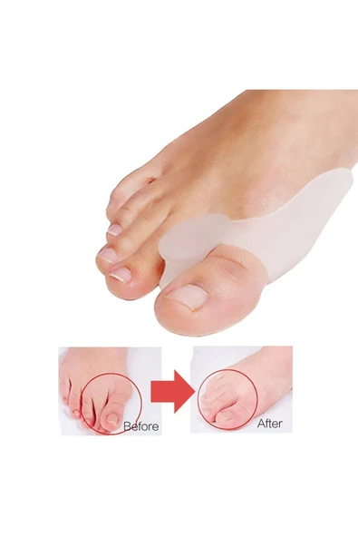 Silikon Çift Hallux Valgus (kemik Çıkıntısı) Sprinti Çekiç Parmak Düzeltici ürün görseli 1