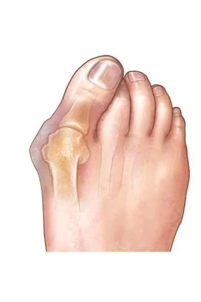 Ten/beyaz Renk Ayak Baş Parmak Bunyon Slikon Kemik Koruyucu Halkalı Sağ Sol Çift - Resim 5