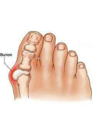 Orta Parmağa Geçen Metatarsal Pad Başparmak Koruyucu - Resim 4